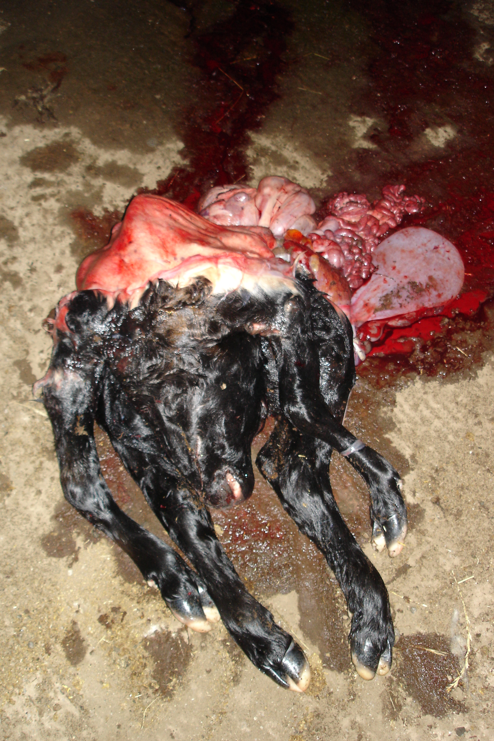 Schistosomus Reflexus