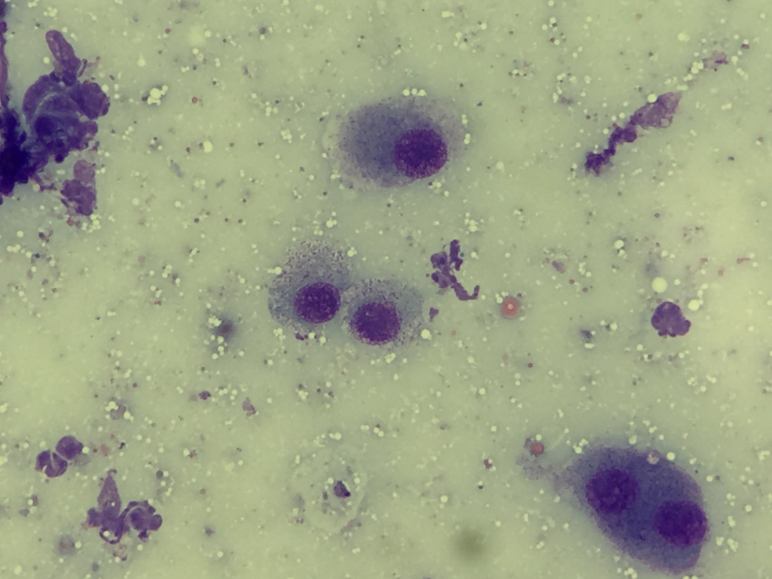 Mast cell tumour - poorly differentiated