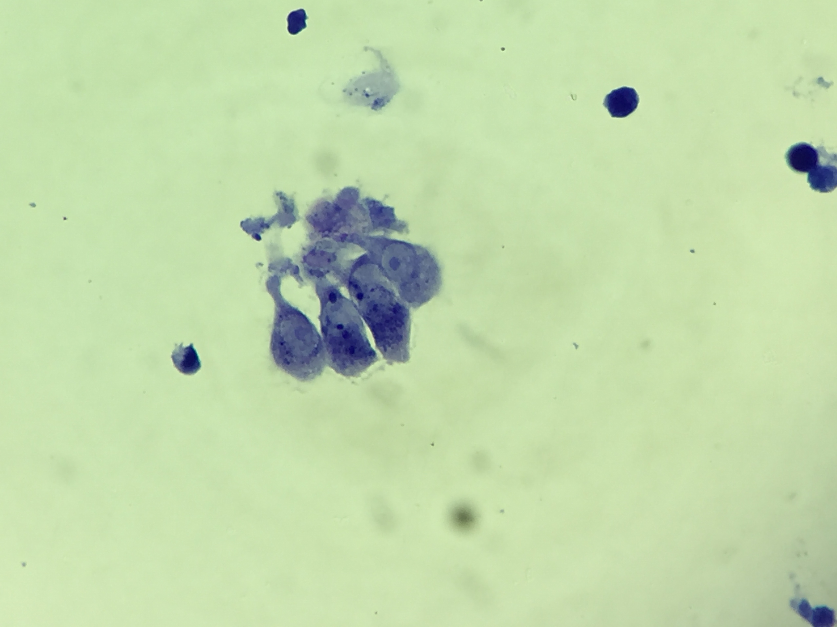 Soft tissue sarcoma