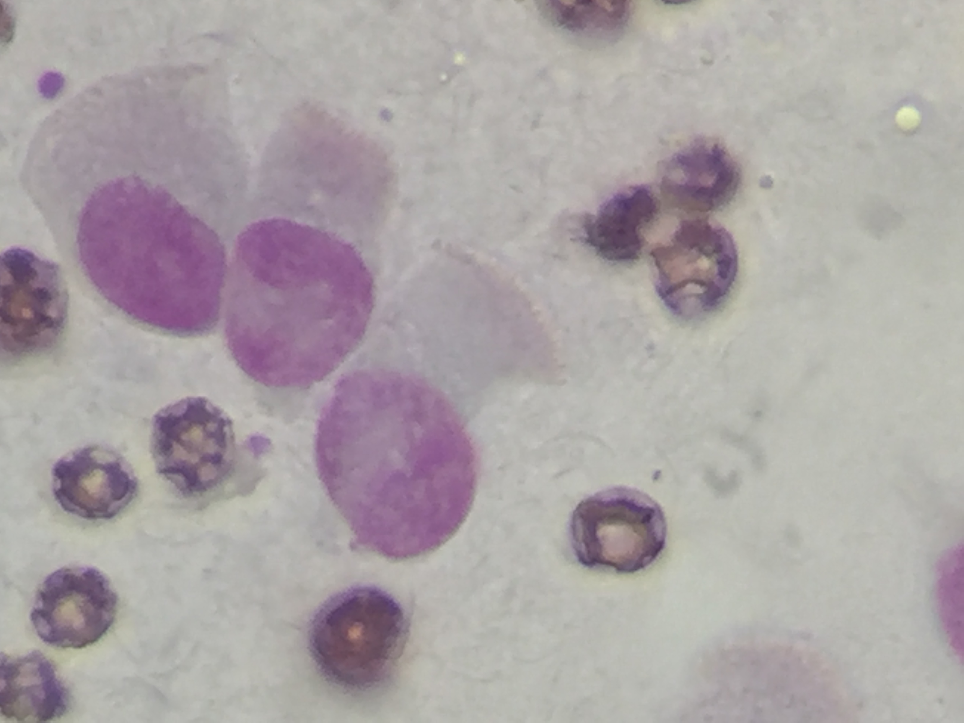 Bronchial mass impression smear