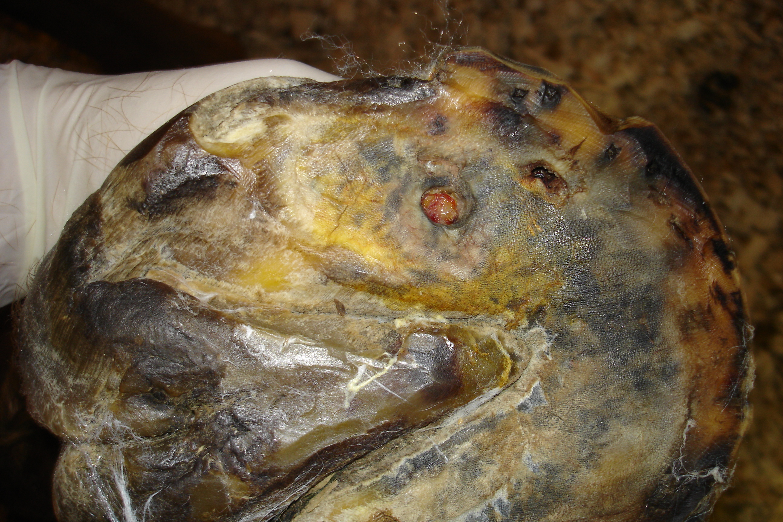 Solar abscess