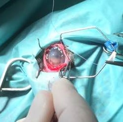 Melting ulcer
