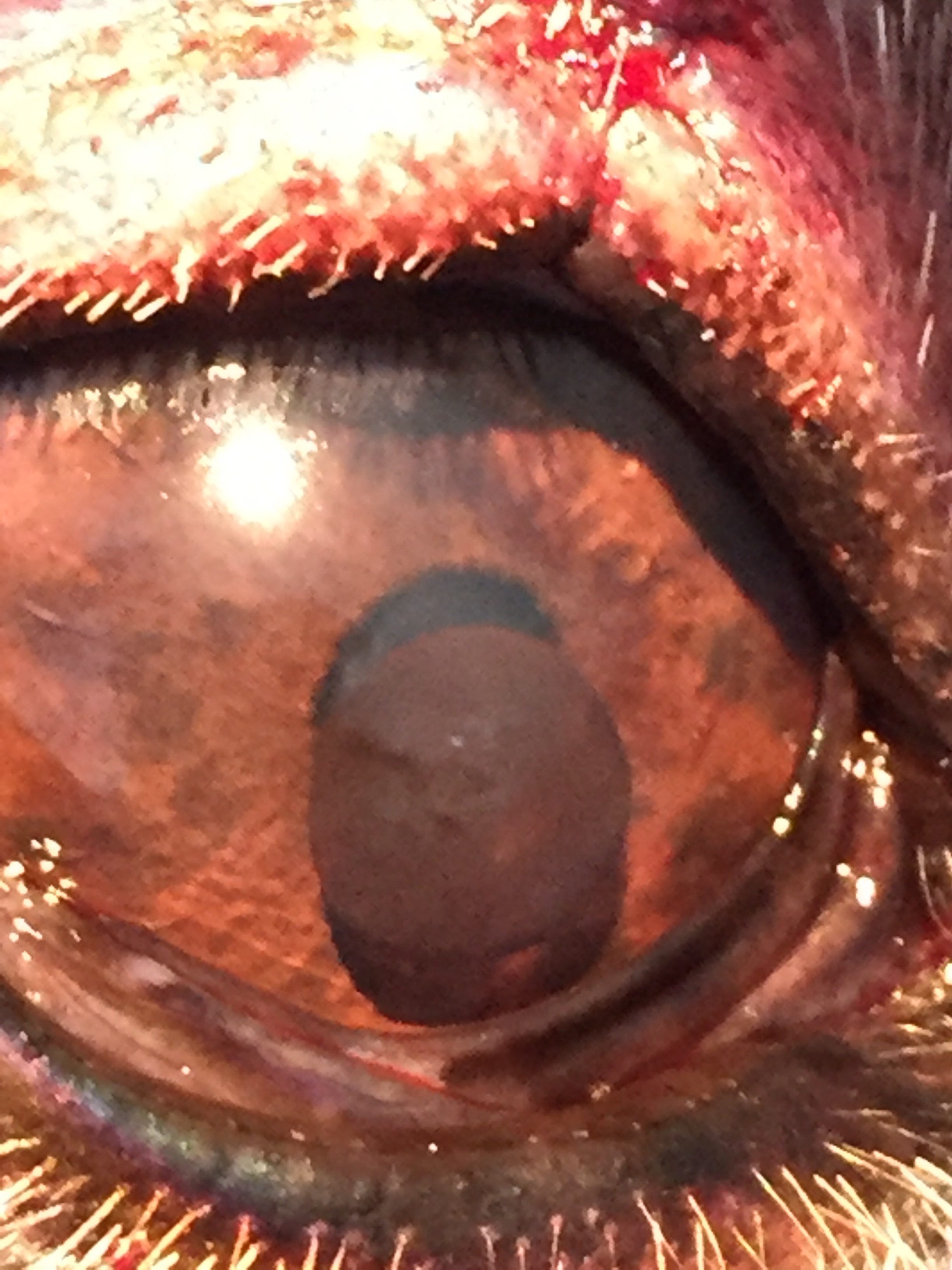 Iris Cysts