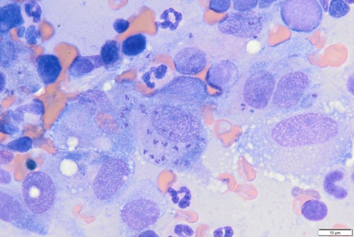 Bone marrow cytology showing macrophages with numerous intracellular organisms consistent with Leishmania species amastigotes (Photo credit Charalampos Attipa).jpg