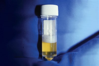 New study supports regular proteinuria monitoring during masitinib treatment